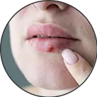 Click here to see the products of category Lip Herpes