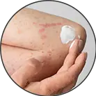 Click here to see the products of category Psoriasis