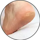 Click here to see the products of category Cracked Heels
