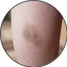 Click here to see the products of category Bruises