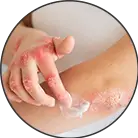 Click here to see the products of category Burns