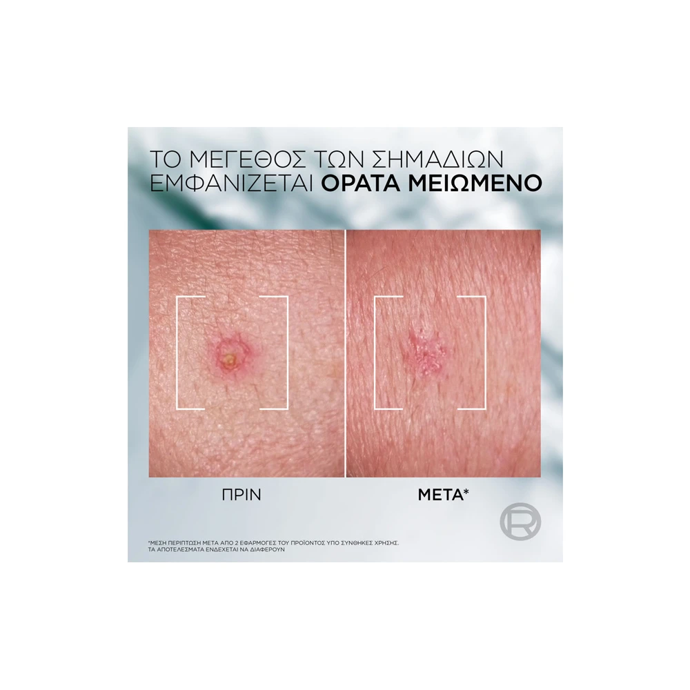L'Oreal Paris Men Expert Derma Control S.O.S Pimple Paste Για Τα Επίμονα Σπυράκια 45ml